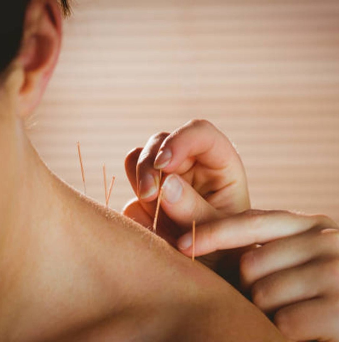Dry Needling